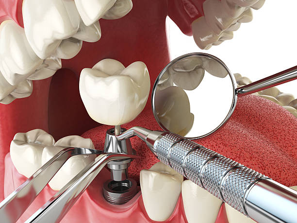 Best Emergency Root Canal Treatment in Lauderdale Lakes, FL